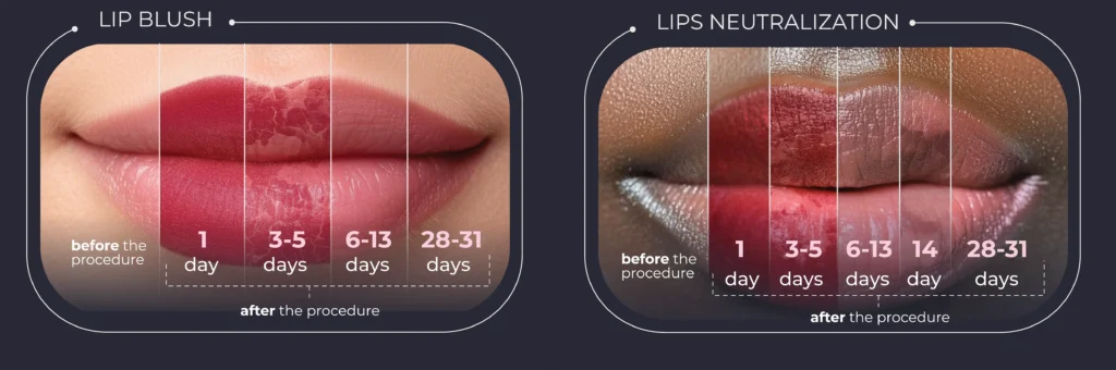 Lips Neutralization Vancouver before and after result