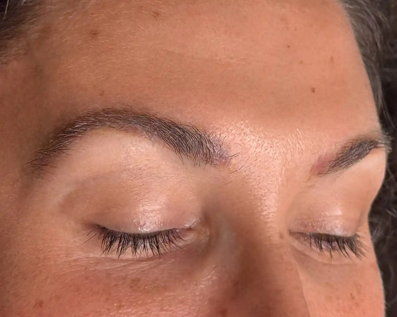 Tattoo removal result after treatment