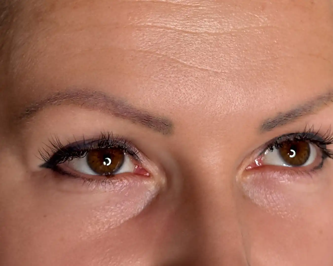 Tattoo removal result after treatment