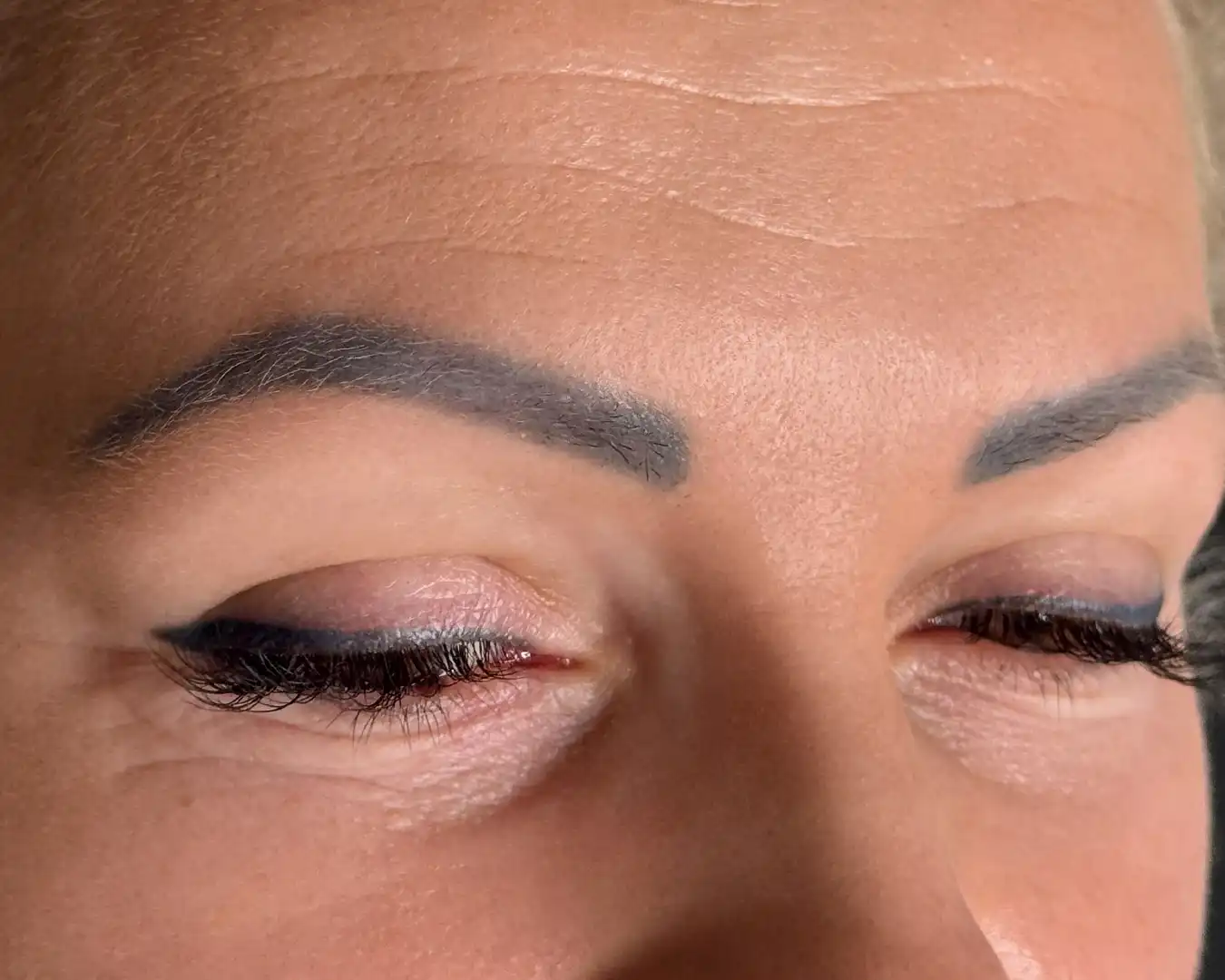 Tattoo removal before treatment